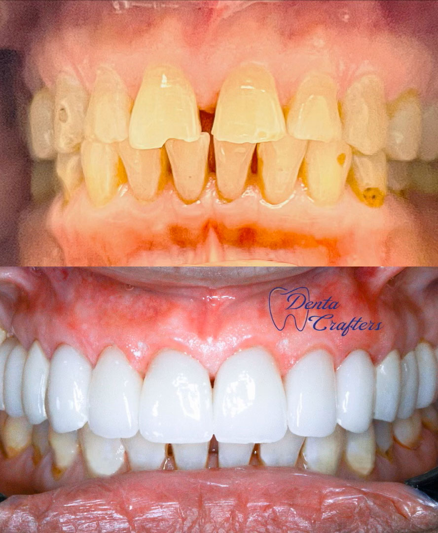 SmilesCrafters | Veneers, Digital Impressions and Oral Exams