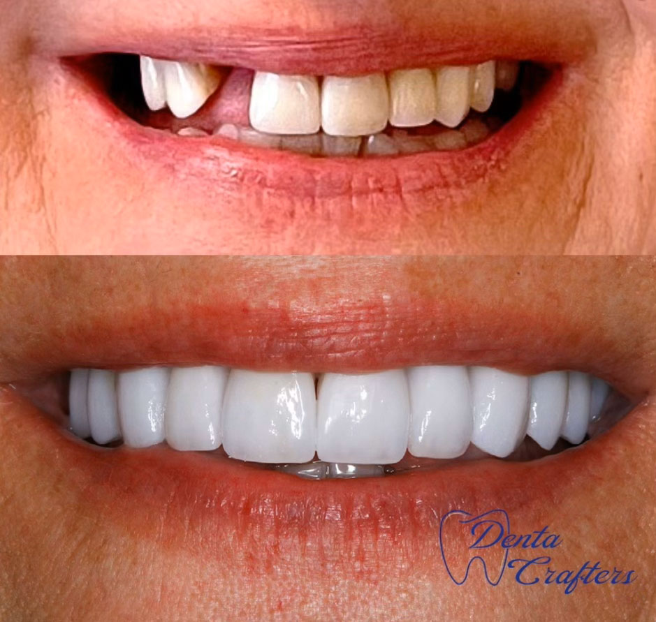 SmilesCrafters | Veneers, Extractions and Crowns